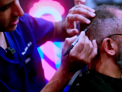 Best hair transplant chicago